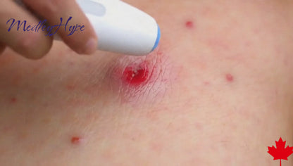 BioZap Your Bites Away – No Creams. No Chemicals.